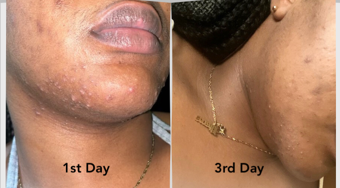 Super Clear Acne Kit –                                        3-Step Blemish &amp; Breakout Treatment image 1